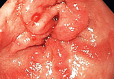 A less common source of dyspnea in scleroderma