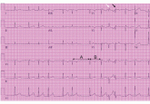 Presumed premature ventricular contractions