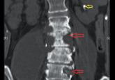 Persistent back pain in a young woman