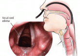 Laryngopharyngeal reflux: More questions than answers