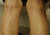 A rash on the legs and palms
