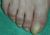 Yellow nails, ankle edema, and pleural effusion