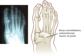 Charcot neuroarthropathy: An often overlooked complication of diabetes
