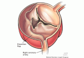 Aortic dissection: Prompt diagnosis and emergency treatment are critical