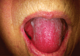 A 66-year-old woman with an enlarged tongue