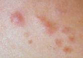 An Unusual Case of Sporadic Hereditary Leiomyomatosis and Renal Cell Carcinoma Syndrome