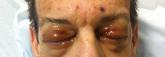 Waxy Indurated Plaques on the Eyelids