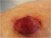 Friable Nodule on the Back  