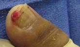 Erythematous Friable Papule Under the Great Toenail