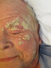 Diffuse Crusting of the Skin