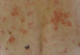 Non–Drug-Induced Pemphigus Foliaceus in a Patient With Rheumatoid Arthritis