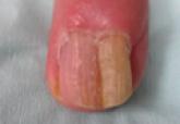 Onychomatricoma: A Rare Case of Unguioblastic Fibroma of the Fingernail Associated With Trauma