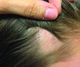 Patch of Hair Loss on the Scalp