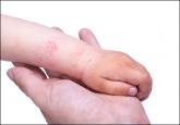 A Practical Overview of Pediatric Atopic Dermatitis, Part 3: Differential Diagnosis, Comorbidities, and Measurement of Disease Burden