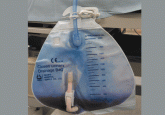 Purple urine in a woman with chronic kidney disease