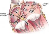 Ablation of atrial fibrillation: What can we tell our patients?
