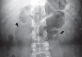 Recurrent pyelonephritis as a sign of ‘sponge kidney’