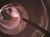 Adenoma detection rates affect CRC rates, mortality