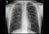 Rule out pulmonary tuberculosis: Clinical and radiographic clues for the internist