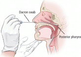 A 49-year-old woman with a persistent cough