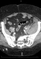 Case Report: Spontaneous Retroperitoneal Bleeding Masking as Left Lower Quadrant Abdominal Pain