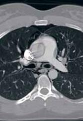 Case Report: Sudden Chest Pain Following an Asthma Attack
