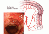 Clinical approach to colonic ischemia