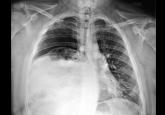 Eventration of the diaphragm presenting as spontaneous pneumothorax