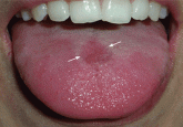 Erythema and atrophy on the tongue