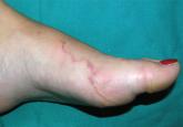 A serpiginous, itchy rash on the foot