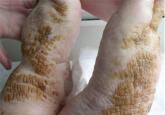 Cornflake-like scales on the ankles and feet