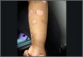 Well-defined macules on young girl’s forearms