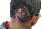 Inflammatory masses on boy’s scalp
