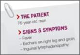 Fever • eschars on right leg and groin • inguinal lymphadenopathy • Dx?