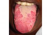 Geographic tongue