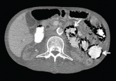 Pneumatosis cystoides intestinalis: Is surgery always indicated?