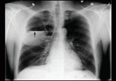 Lung air-fluid level in a smoker