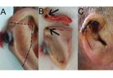 Occult satellite metastasis of an auricular melanoma