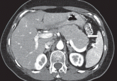 Autoimmune pancreatitis: A mimic of pancreatic cancer