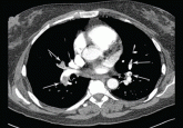 A 51-year-old woman with dyspnea