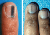 Evaluation of nail lines: Color and shape hold clues