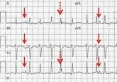 Respiratory artifact: A second vital sign on the electrocardiogram