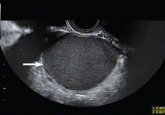 Role of imaging in endometriosis