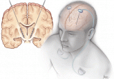 Deep brain stimulation: What can patients expect from it?