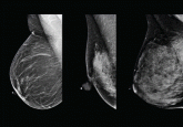 The conundrum of explaining breast density to patients