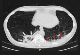 An intravenous drug user with persistent dyspnea and lung infiltrates