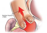 When does asymptomatic aortic stenosis warrant surgery? Assessment techniques