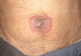 A lump in the umbilicus