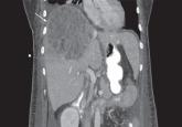 Pyogenic liver abscess