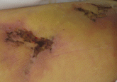 Necrotic skin lesions after hemodialysis